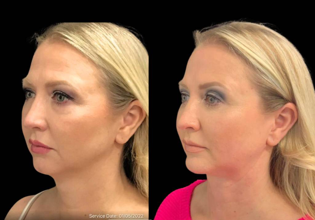 49-year-old-female-chin-implant-before-and-after-three-quarter-view-2.jpg