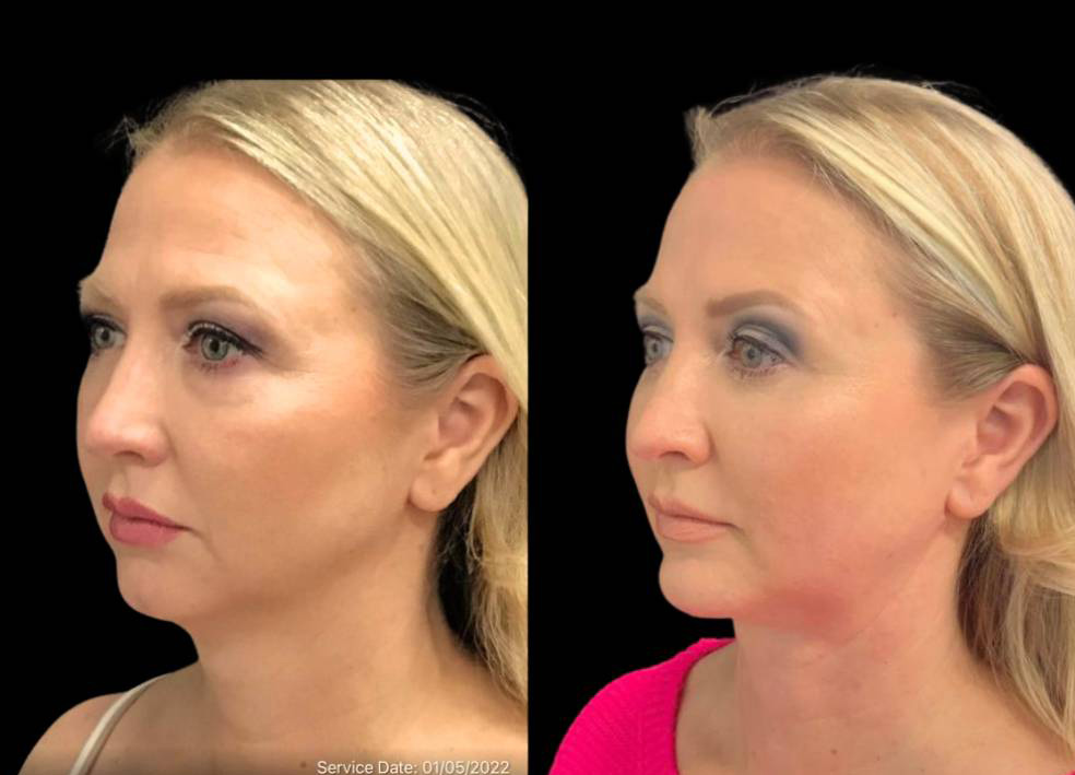 49-year-old-female-chin-implant-before-and-after-three-quarter-view-2.jpg