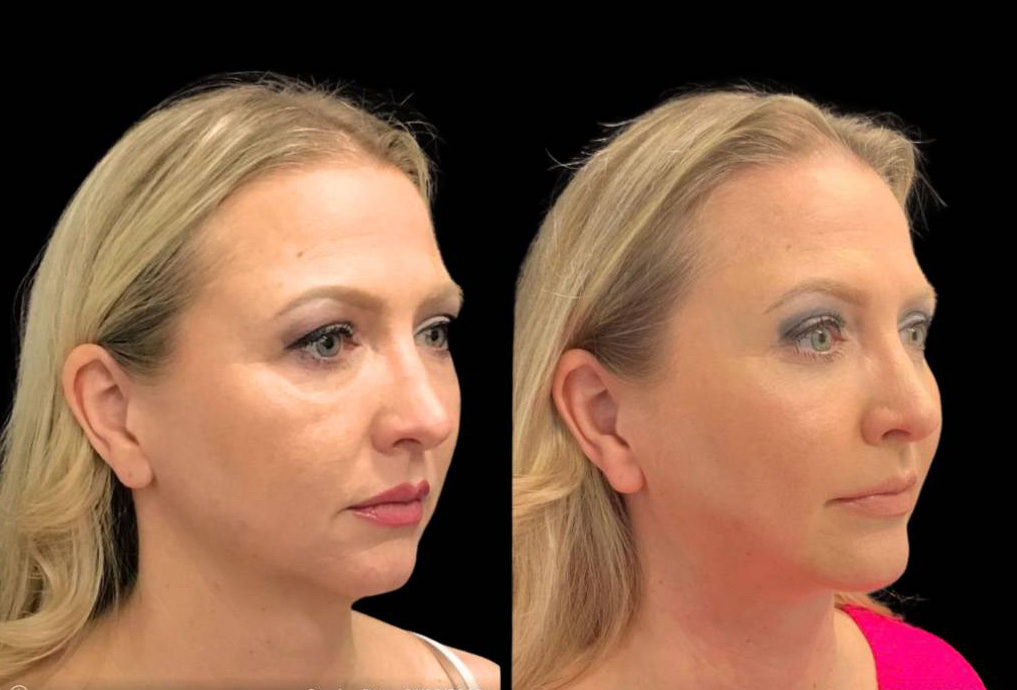 49-year-old-female-chin-implant-before-and-after-three-quarter-view.jpg