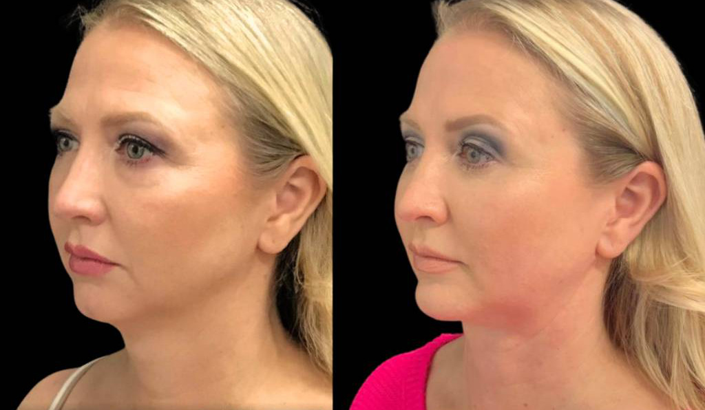 49-year-old-female-chin-implant-before-and-after-three-quarter-view-2.jpg