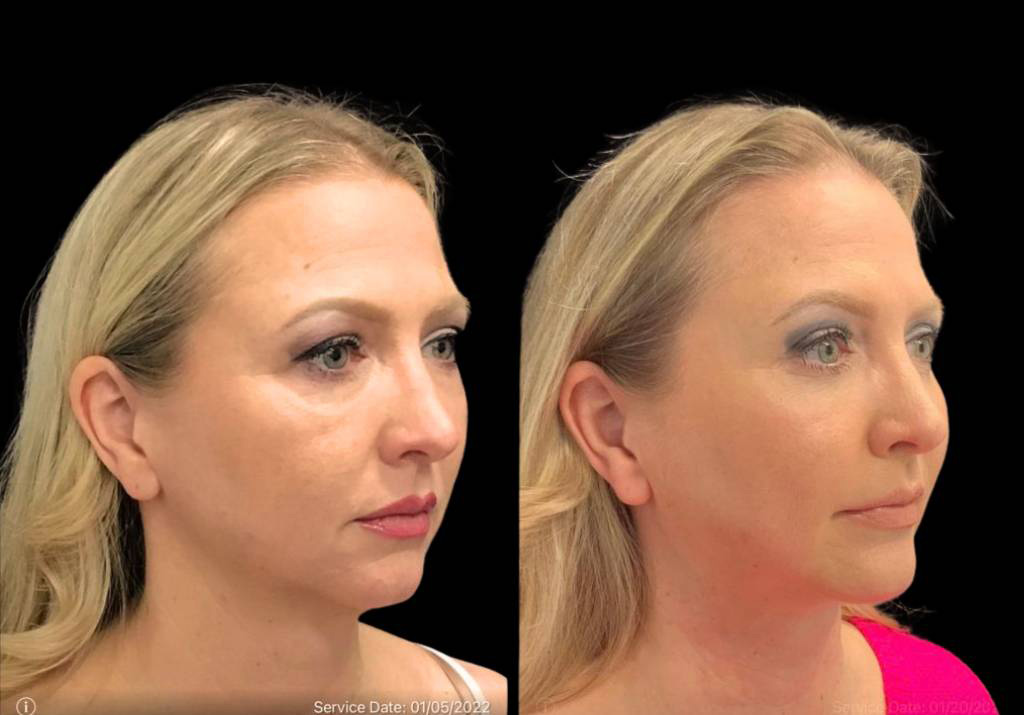 49-year-old-female-chin-implant-before-and-after-three-quarter-view.jpg