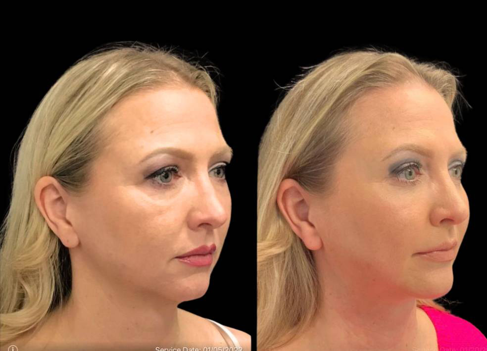 49-year-old-female-chin-implant-before-and-after-three-quarter-view.jpg