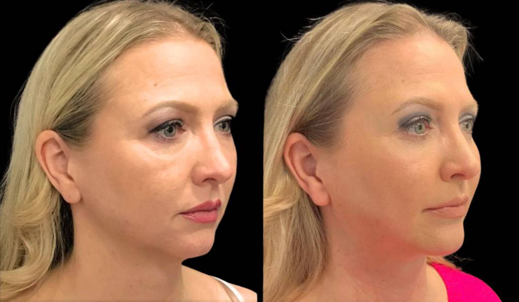 49-year-old-female-chin-implant-before-and-after-three-quarter-view.jpg