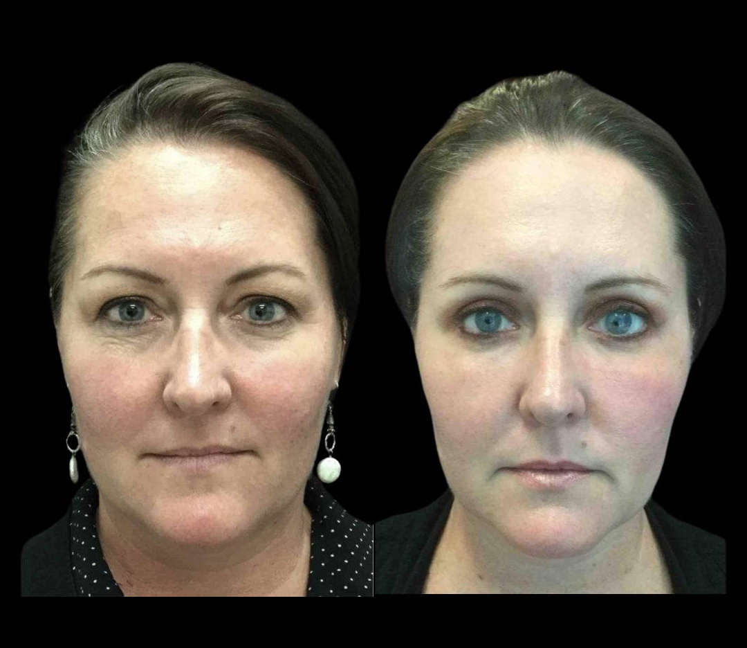 49-year-old-female-fractional-co2-laser-treatment-before-and-after-front-view.jpg