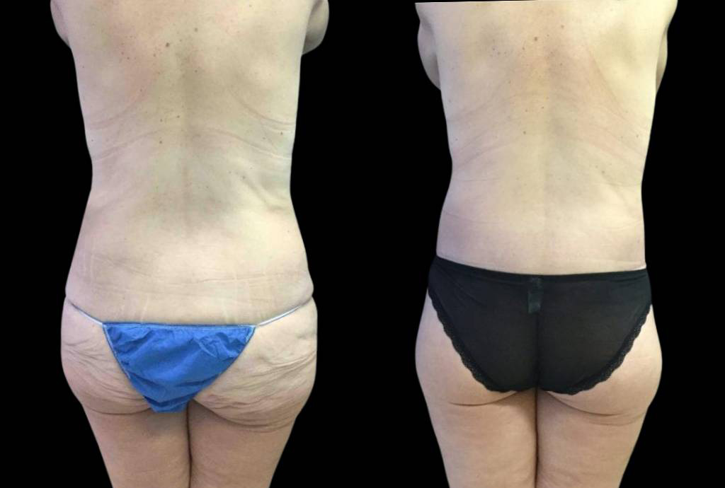 49-year-old-female-lower-body-lift-before-and-after-back-view.jpg