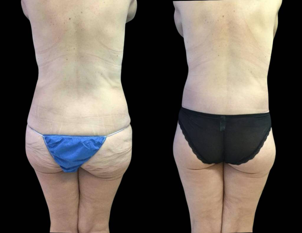 49-year-old-female-lower-body-lift-before-and-after-back-view.jpg