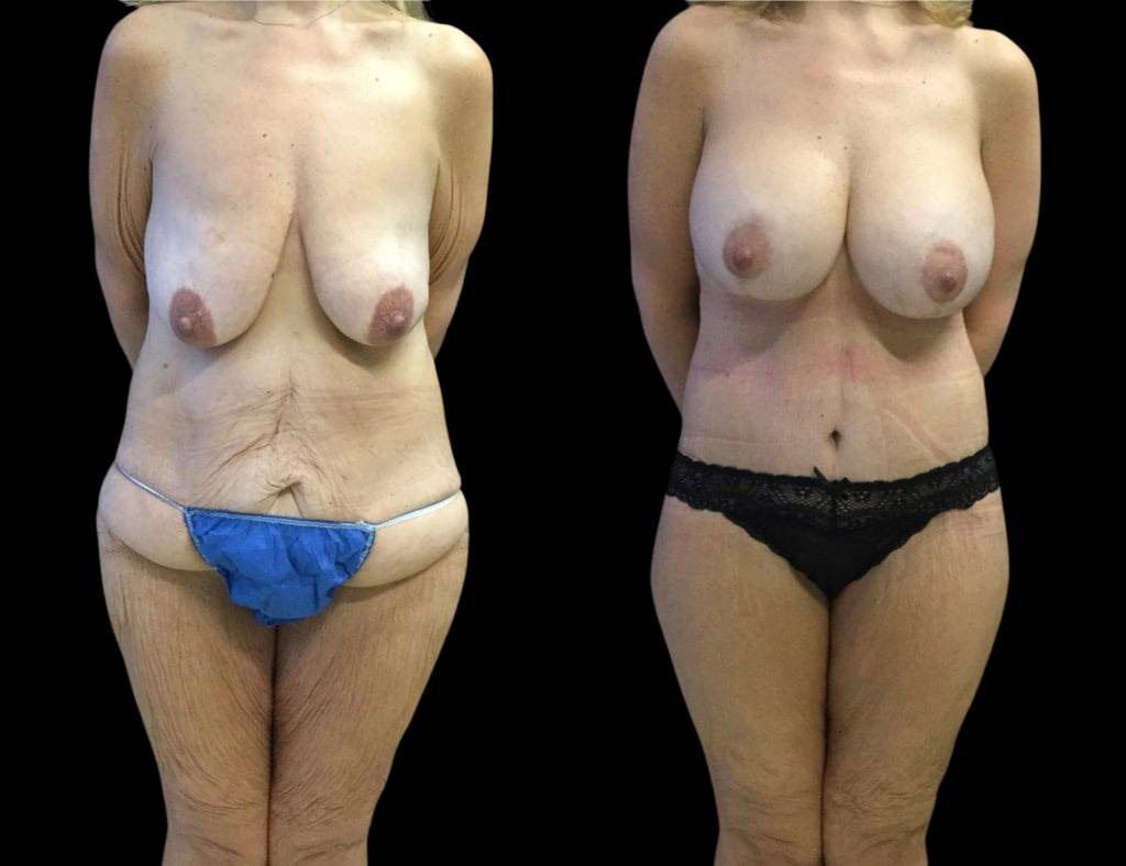 49-year-old-female-lower-body-lift-before-and-after-front-view.jpg