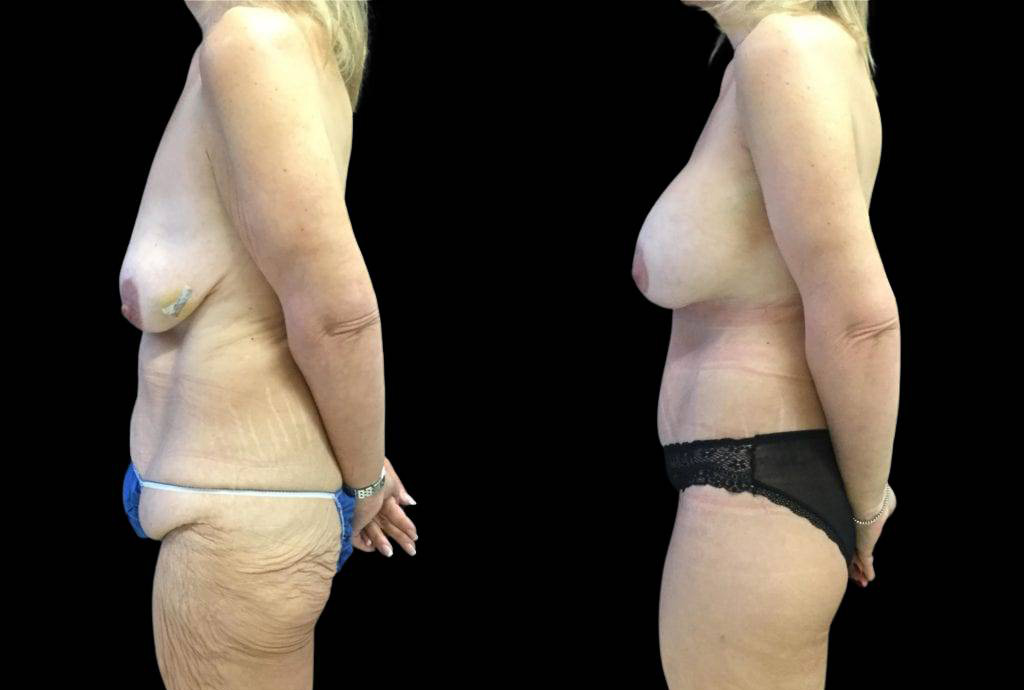 49-year-old-female-lower-body-lift-before-and-after-side-view.jpg