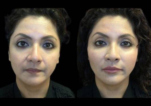 49-year-old-female-radiesse-before-and-after-front-view-16287.jpg