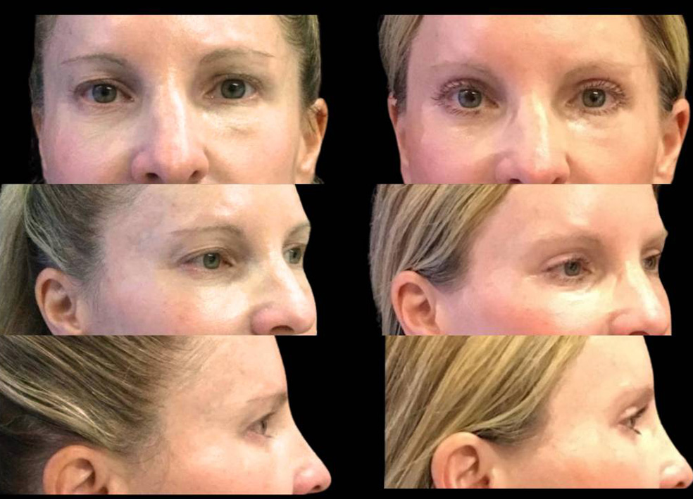 49-year-old-female-upper-eyelid-lift-before-and-after-front-view-28254-1.jpg