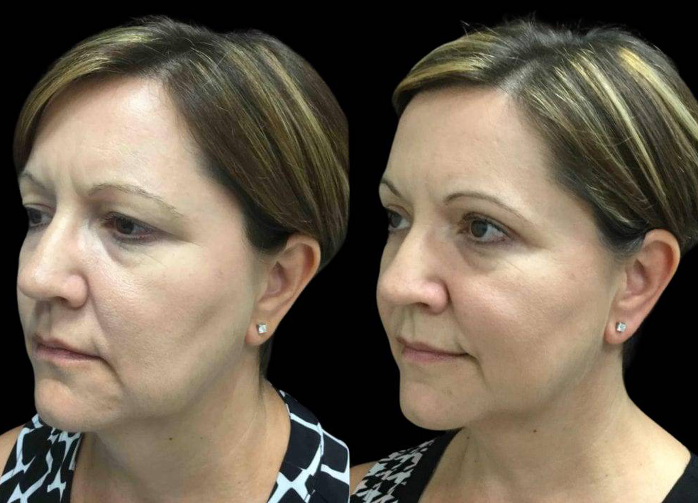 49-year-old-female-upper-eyelid-lift-before-and-after-three-quarter-view-21705.jpg