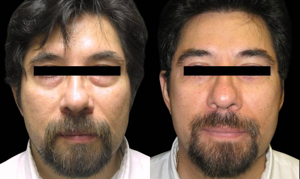 49-year-old-male-lower-eyelid-lift-before-and-after-front-view-.jpg