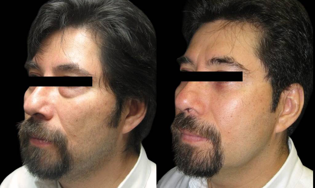 49-year-old-male-lower-eyelid-lift-before-and-after-three-quarters-view-.jpg
