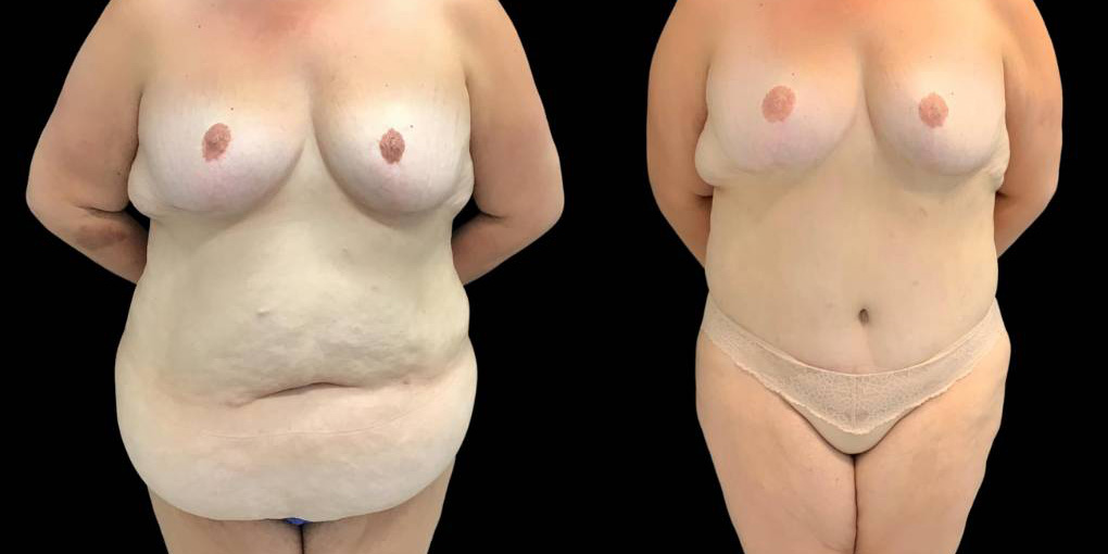 49-yr-old-female-before-and-after-abdominoplasty-left-view