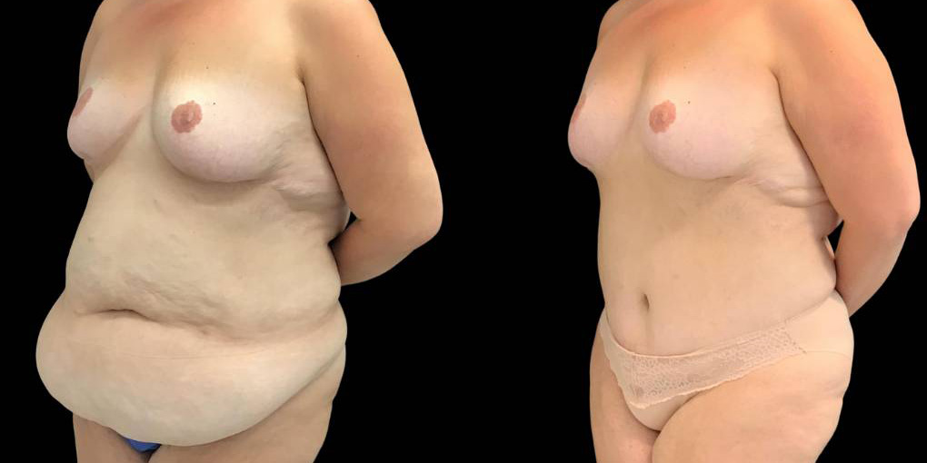 49-yr-old-female-before-and-after-abdominoplasty-left-view