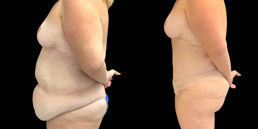49-yr-old-female-before-and-after-abdominoplasty-left-view