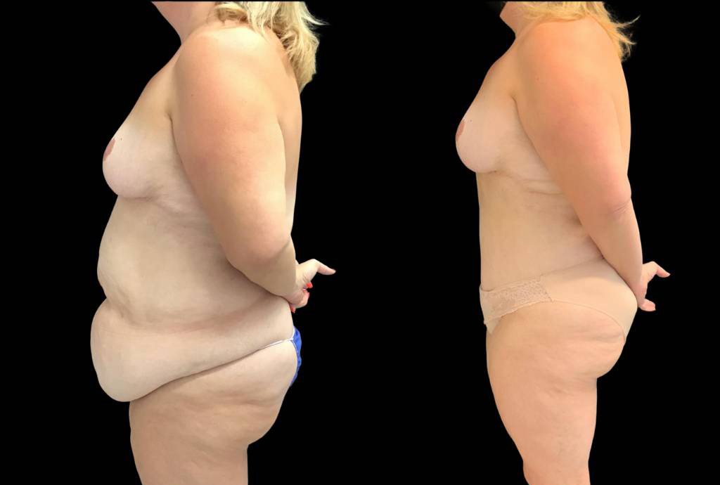 49-yr-old-female-before-and-after-abdominoplasty-left-view.jpg
