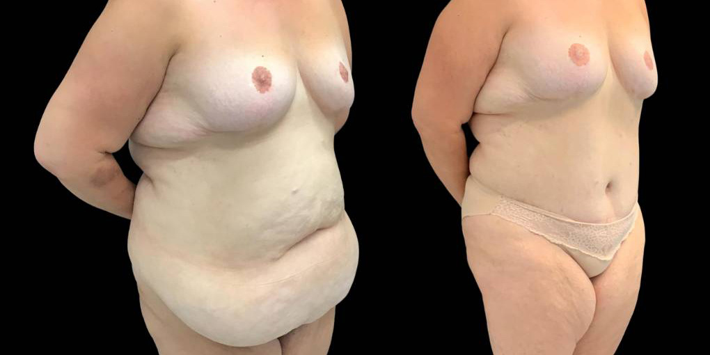 49-yr-old-female-before-and-after-abdominoplasty-left-view