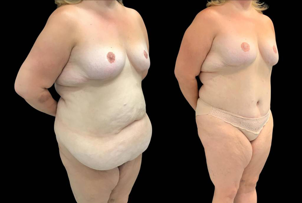 49-yr-old-female-before-and-after-abdominoplasty-right-three-quarter-view.jpg