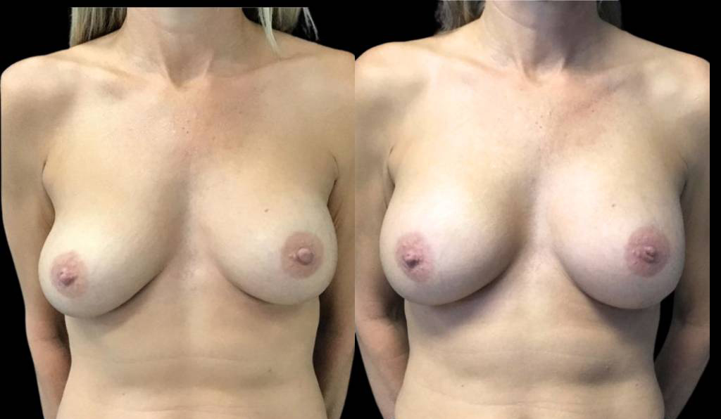 50-year-old-female-breast-implant-exchange-before-and-after-front-view.jpg