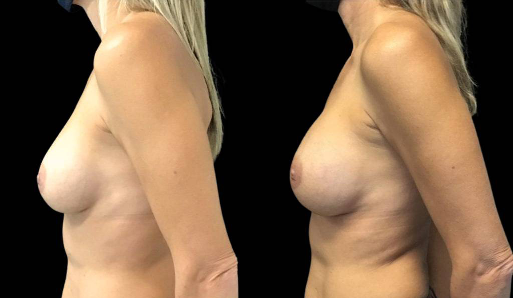 50-year-old-female-breast-implant-exchange-before-and-after-side-view.jpg