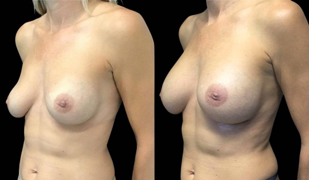 50-year-old-female-breast-implant-exchange-before-and-after-three-quarter-view.jpg