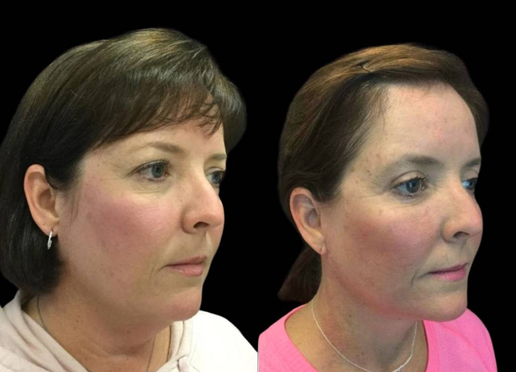50-year-old-female-facelift-before-and-after-three-quarter-view-23591.jpg