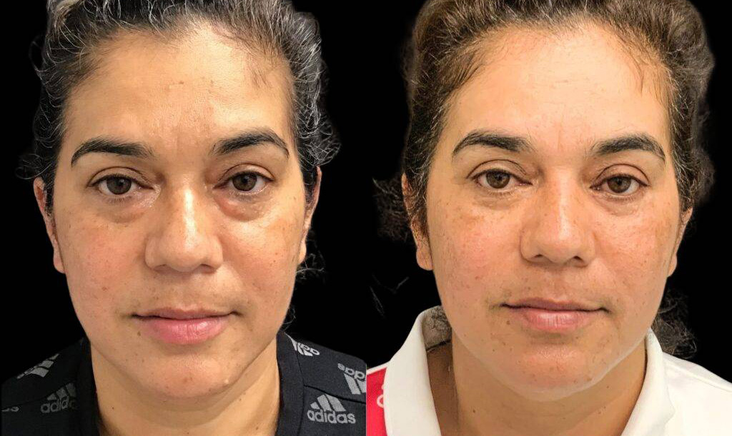 50-year-old-female-lower-eyelid-lift-before-and-after-front-view.jpg