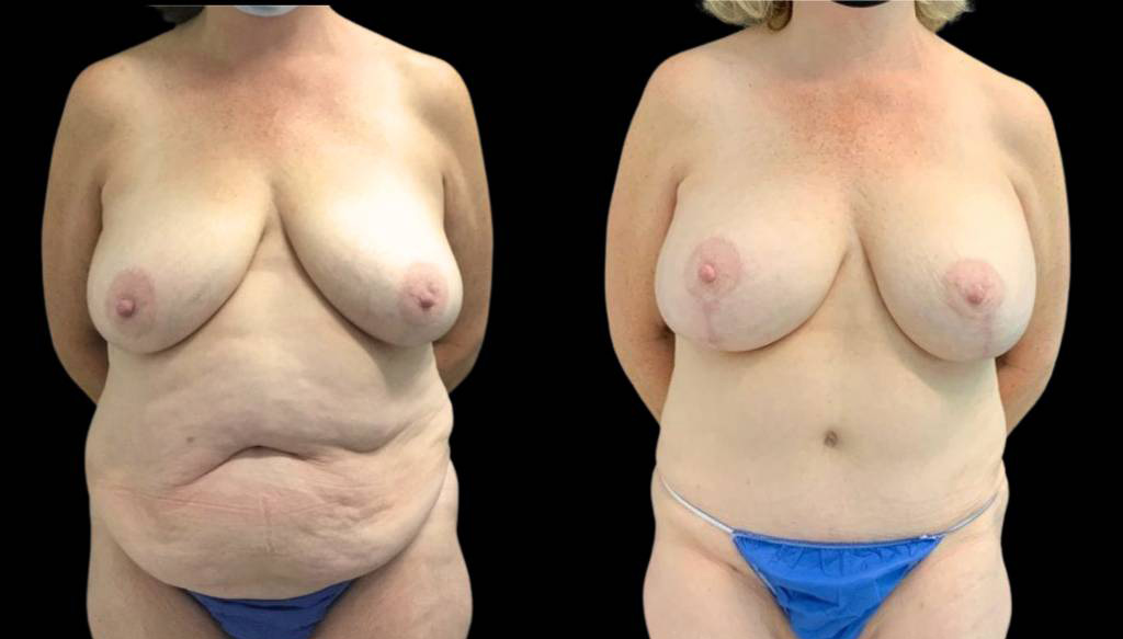50-year-old-female-tummy-tuck-before-and-after-front-view.jpg