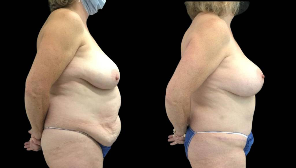 50-year-old-female-tummy-tuck-before-and-after-side-view.jpg