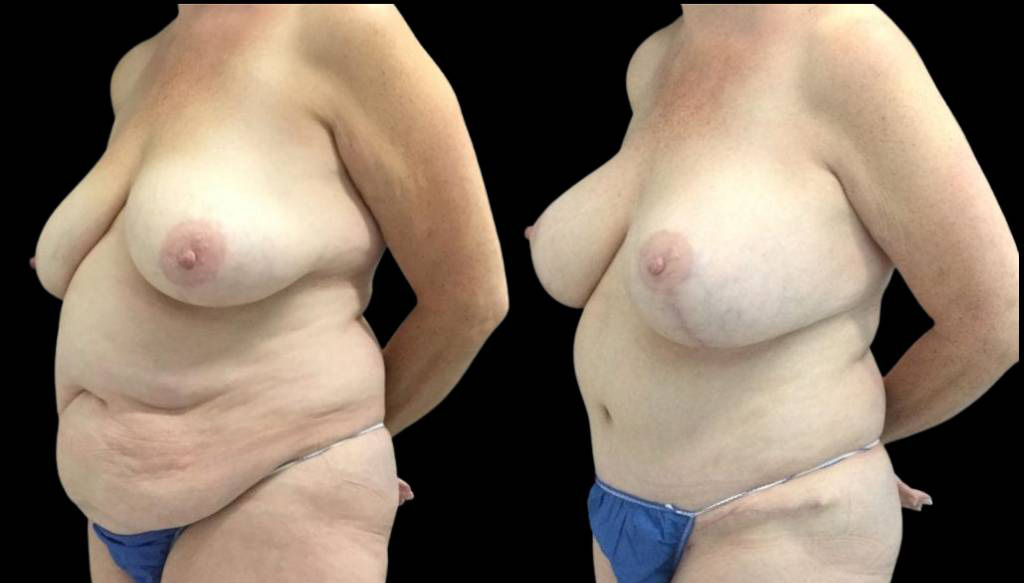 50-year-old-female-tummy-tuck-before-and-after-three-quarter-view.jpg
