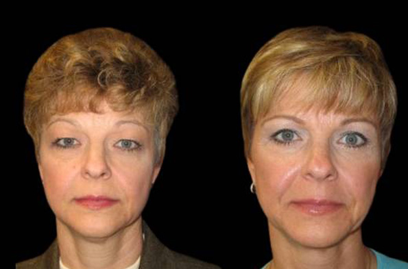 50-year-old-female-upper-and-lower-eyelid-lift-before-and-after-front-view-1798.jpg