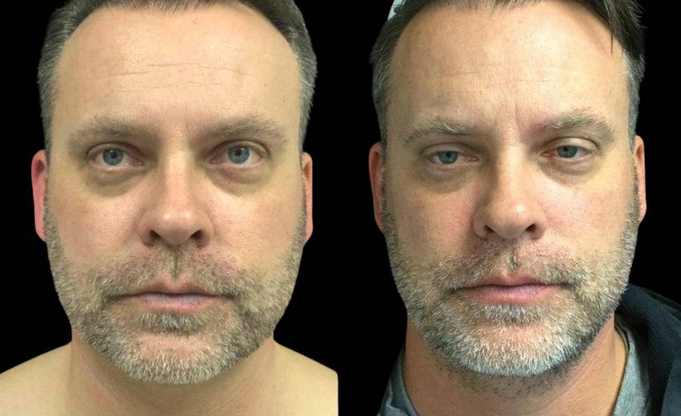 50-year-old-male-necklift-before-and-after-front-view-2116.jpg