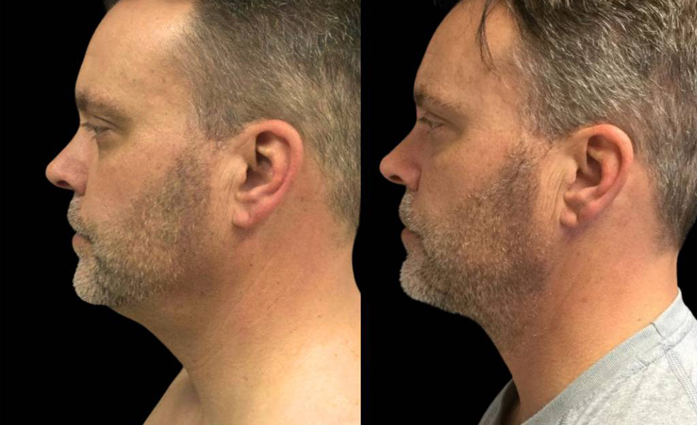 50-year-old-male-necklift-before-and-after-side-view.jpg