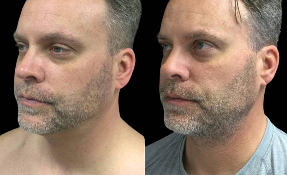 50-year-old-male-necklift-before-and-after-three-quarter-view.jpg