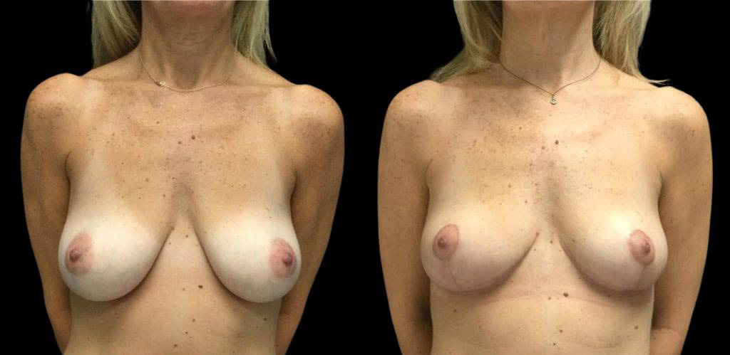 51-year-old-female-breast-reduction-before-and-after-front-view.jpg