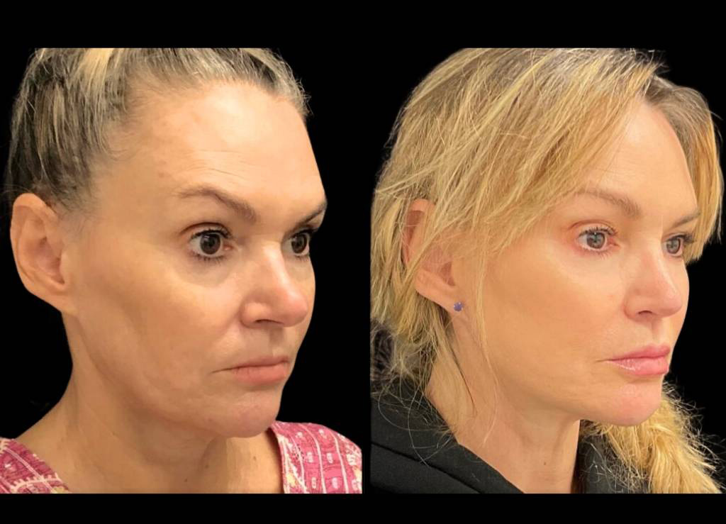 51-year-old-female-facelift-before-and-after-three-quarter-view.jpg