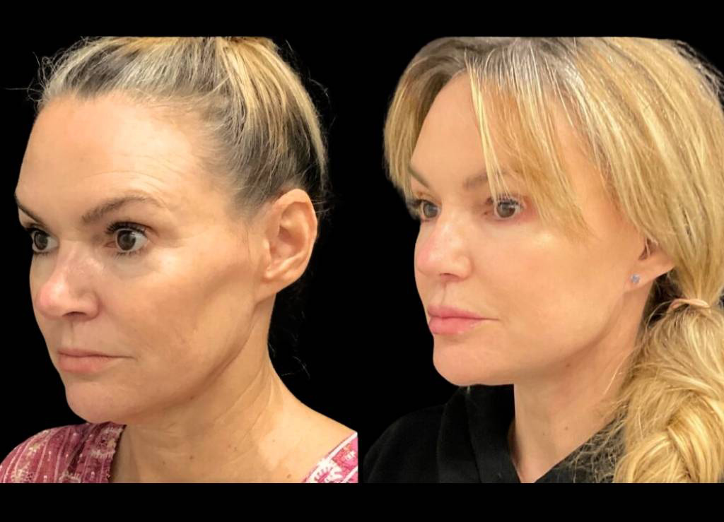 51-year-old-female-facelift-before-and-after-three-quarter-view-33991.jpg