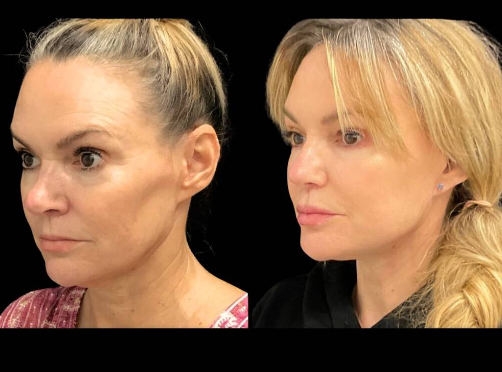 51-year-old-female-facelift-before-and-after-three-quarter-view-33991.jpg