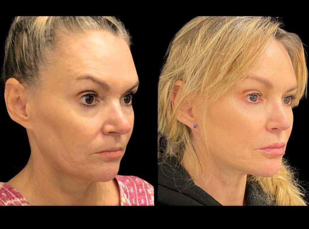 51-year-old-female-facelift-before-and-after-three-quarter-view.jpg