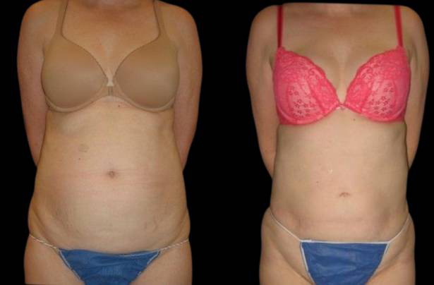 51-year-old-female-laser-lipo-before-and-after-front-view.jpg