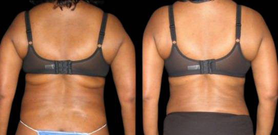 51-year-old-female-liposuction-before-and-after-back-view.jpg