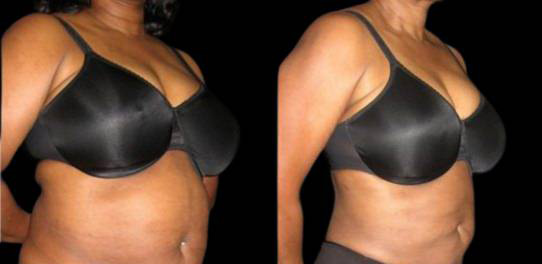 51-year-old-female-liposuction-before-and-after-three-quarters-view.jpg