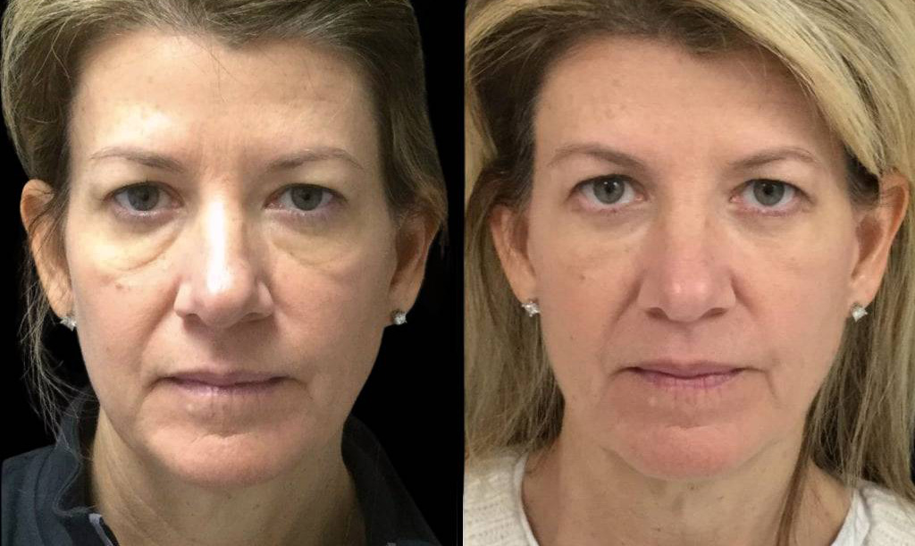 51-year-old-female-lower-eyelid-lift-before-and-after-front-view-24139.jpg