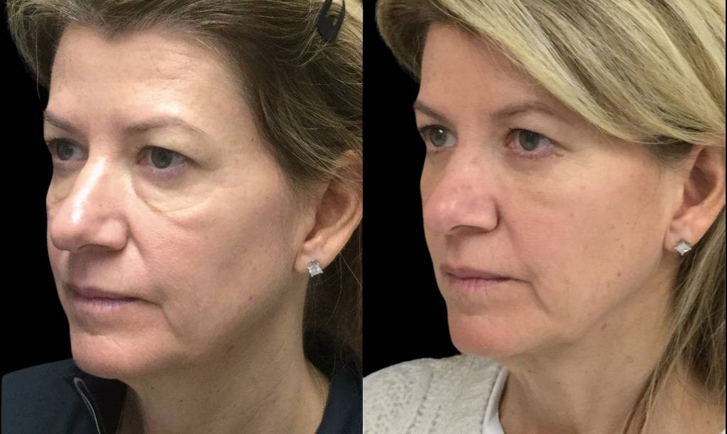 51-year-old-female-lower-eyelid-lift-before-and-after-three-quarter-view.jpg