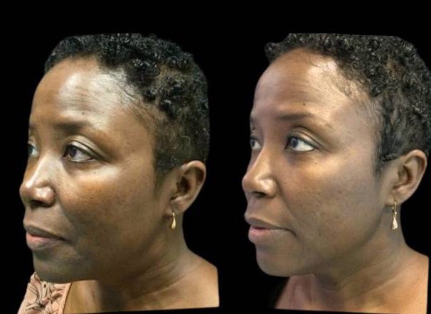 51-year-old-female-microneedling-before-and-after-1.jpg