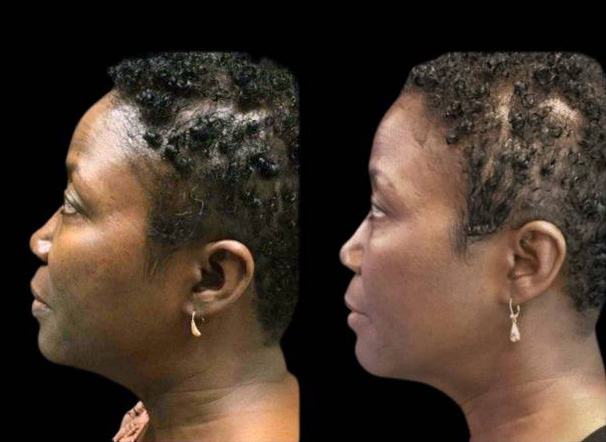 51-year-old-female-microneedling-before-and-after-2.jpg