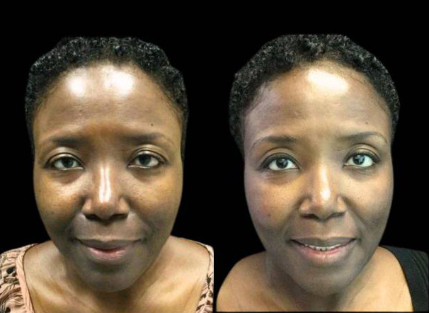 51-year-old-female-microneedling-before-and-after.jpg