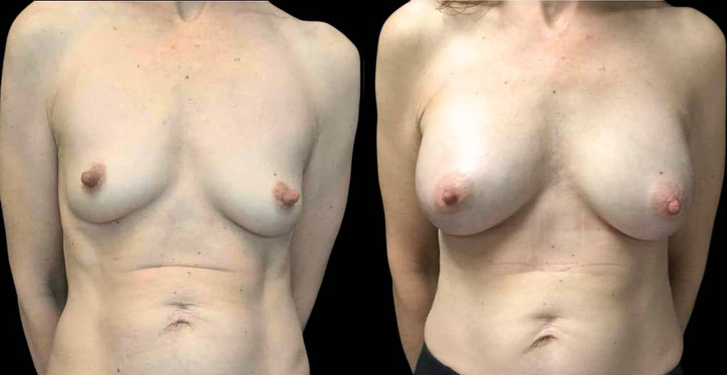 51-year-old-female-nipple-reduction-before-and-after-front-view.jpg