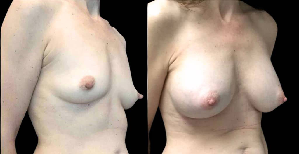 51-year-old-female-nipple-reduction-before-and-after-three-quarter-view.jpg